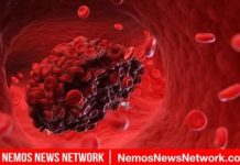 Lethal Blood Clots Develop In 62% Of Covid Vaccinated – Dr. Charles Hoffe of Lytton, BC