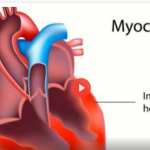 myocarditis (1)
