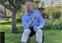 Conservative MP Craig Mackinlay Has Hands And Feet Amputated.