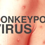 monkeypox-v